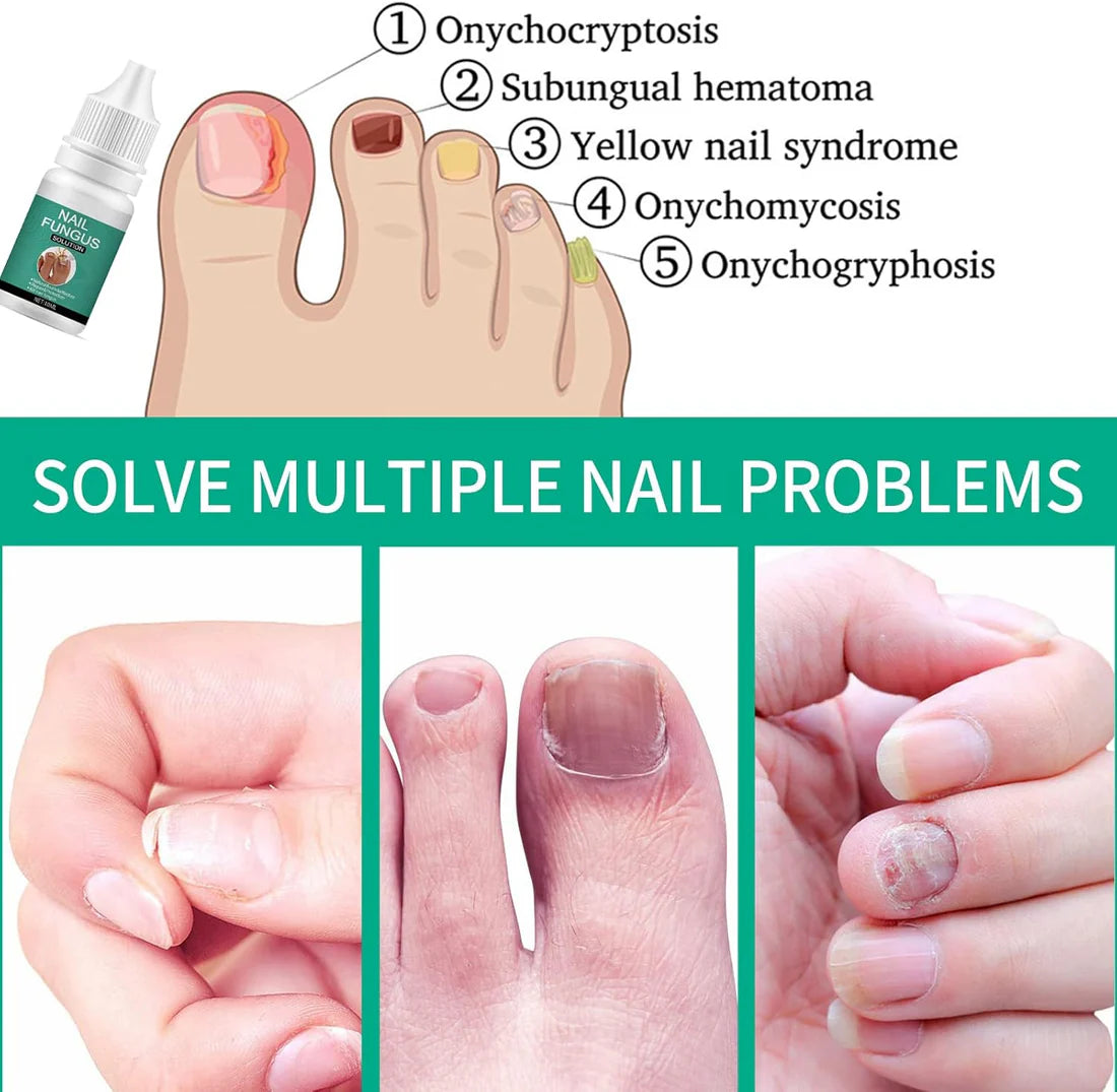 NexusDrop Nail Fungus Solution